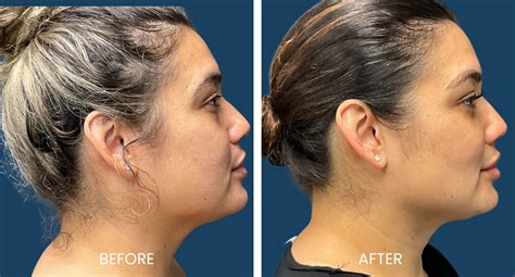 Bichectomy: Buccal fat pad removal surgery .